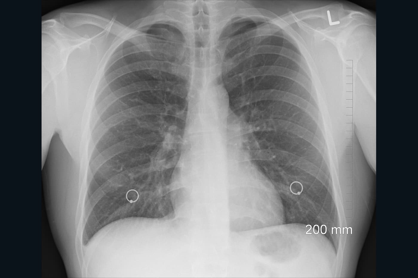 A chest radiograph on a viewing screen.